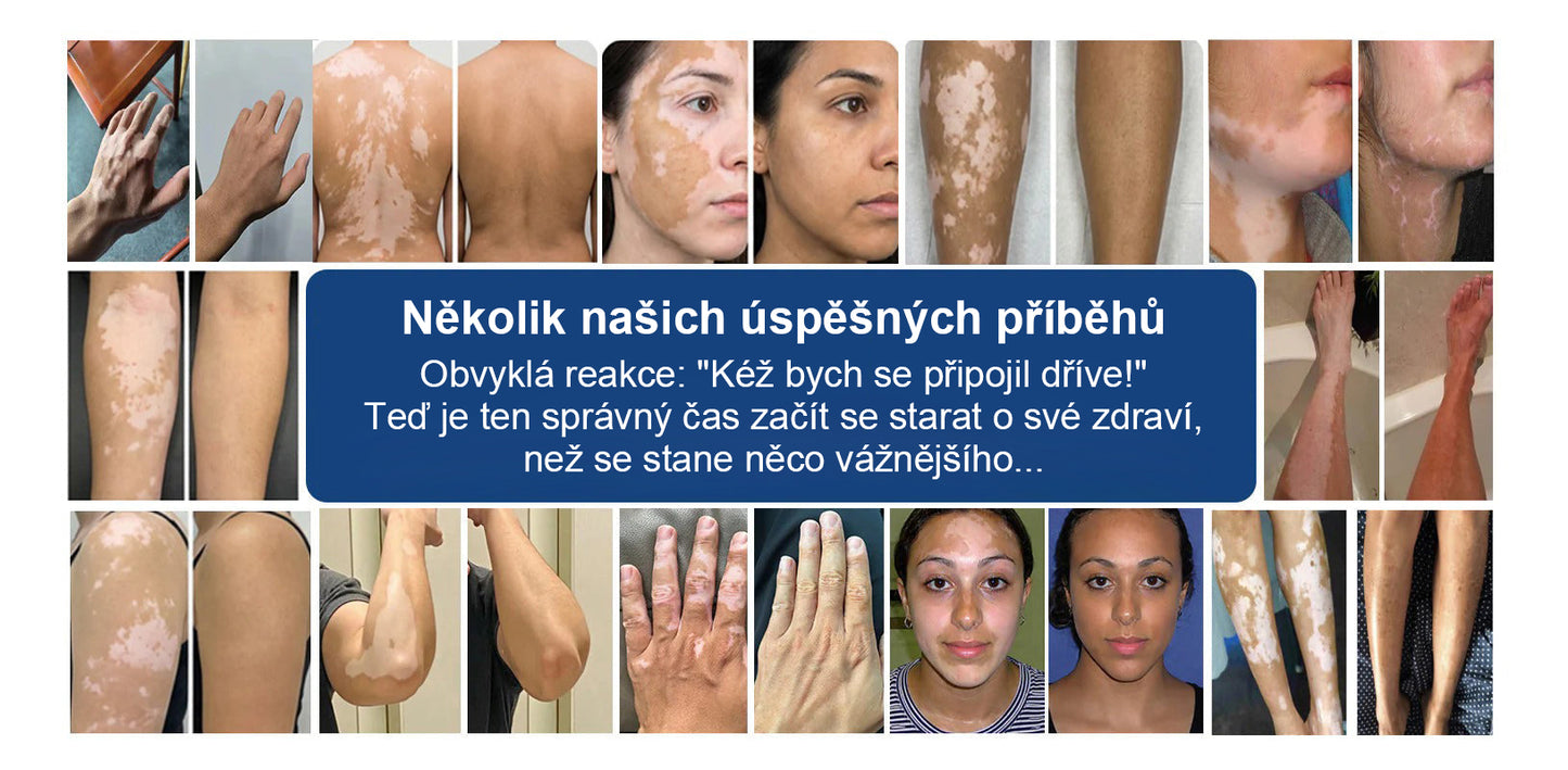 🌿🌿Malenia® Piperin Repigmentační aktivační sprej