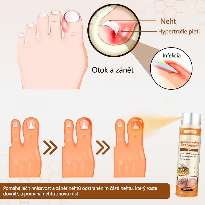 🔥🔥🔥Malenia® NailRescue Včelí jed ve spreji